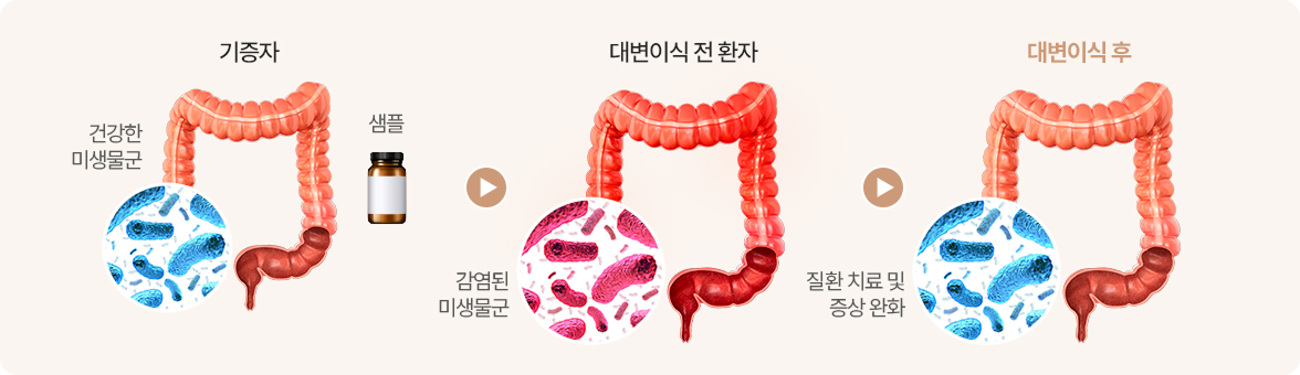 대변이식술