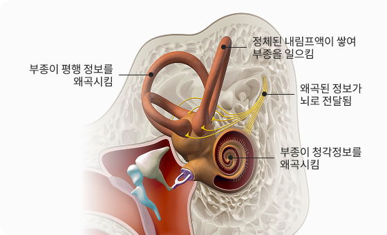 메니에르병